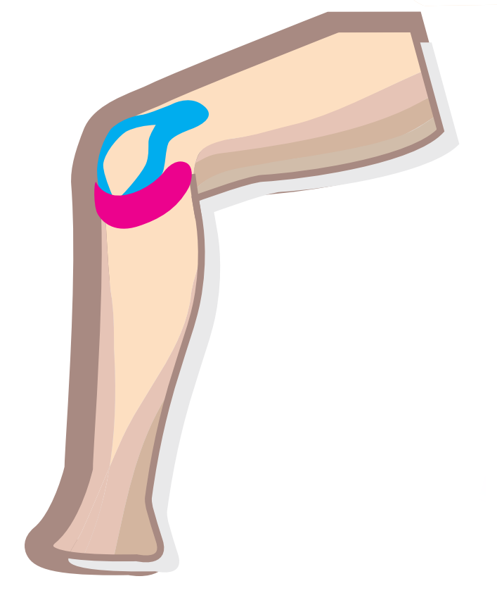 Nasara Kinesiologie Pain Pack Knie Beispiel