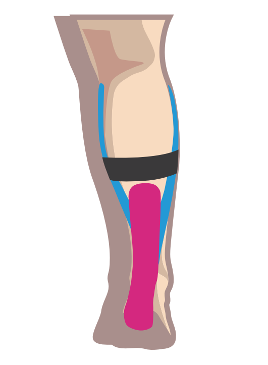 Nasara Kinesiologie Pain Pack Wade Beispiel