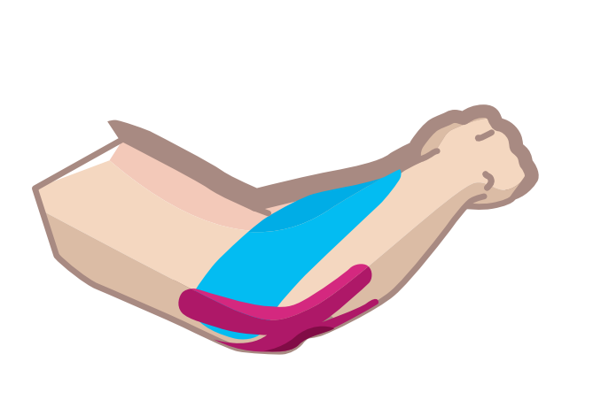 Nasara Kinesiologie Pain Pack Ellenbogen Beispiel