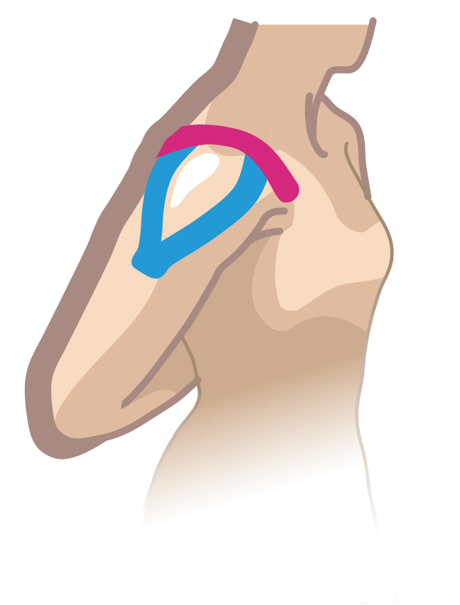 Nasara Kinesiologie Pain Pack Schulter Beispiel