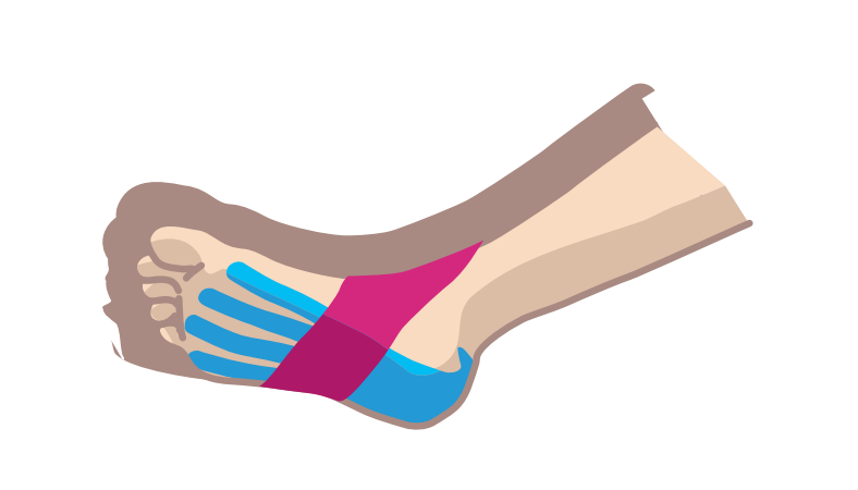 Nasara Kinesiologie Tape Pain Pack Fuss Beispiel