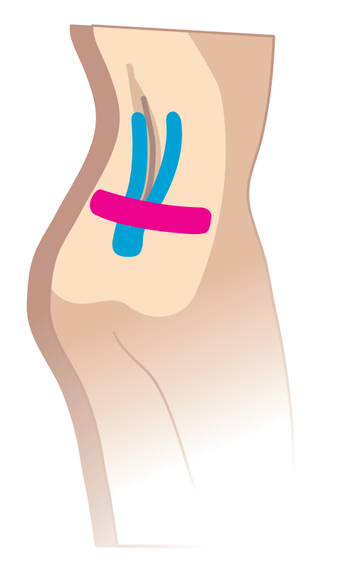 Nasara Kinesiologie Pain Pack unterer Rücken