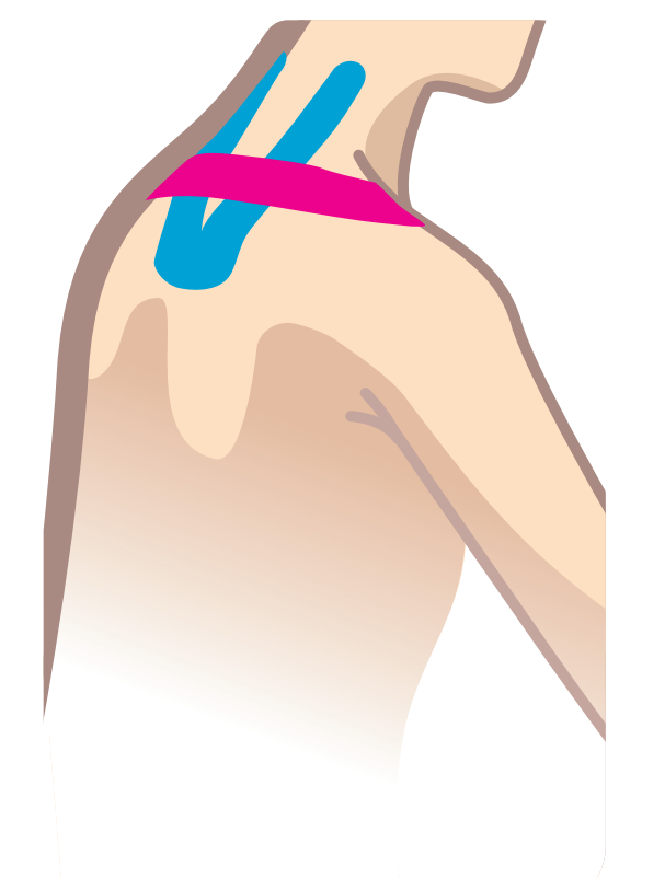 Nasara Kinesiologie Pain Pack Nacken Beispiel
